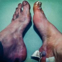 Blisters and frozen toes on Pat Morrow's feet, aftermath of making first winter traverse of Mt Assiniboine 1971. At home in basement of Jean's Beauty Salon, Calgary, AB while going to Journalism school at SAIT.